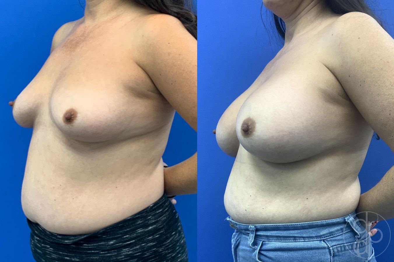 Before and after Breast Augmentation case 29611 - Angle 3