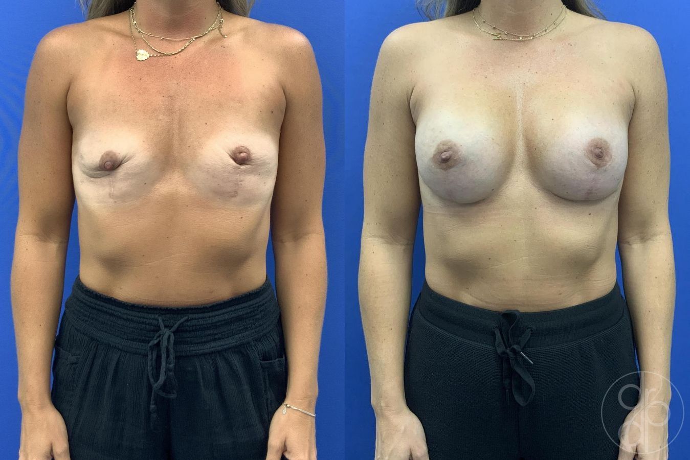 Before and after procedure result