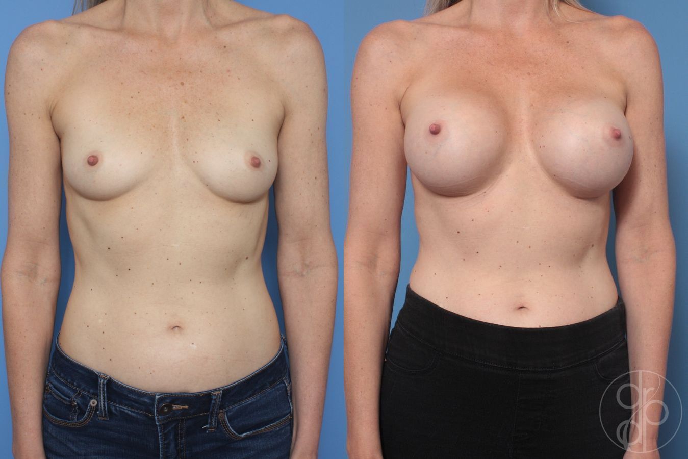 Before and after Breast Augmentation case 29959