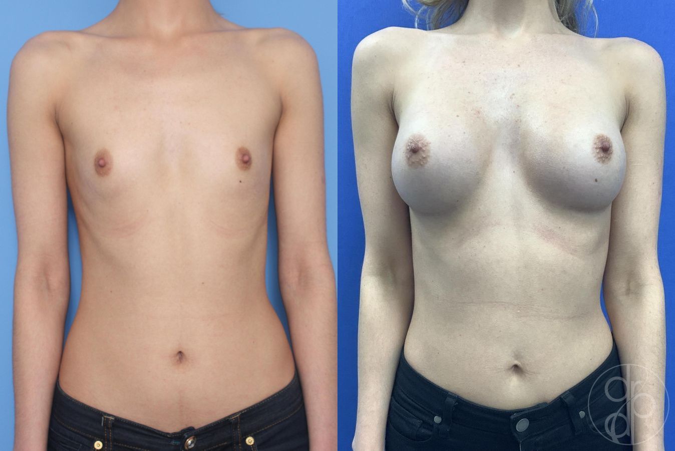 Before and after Breast Augmentation case 29935