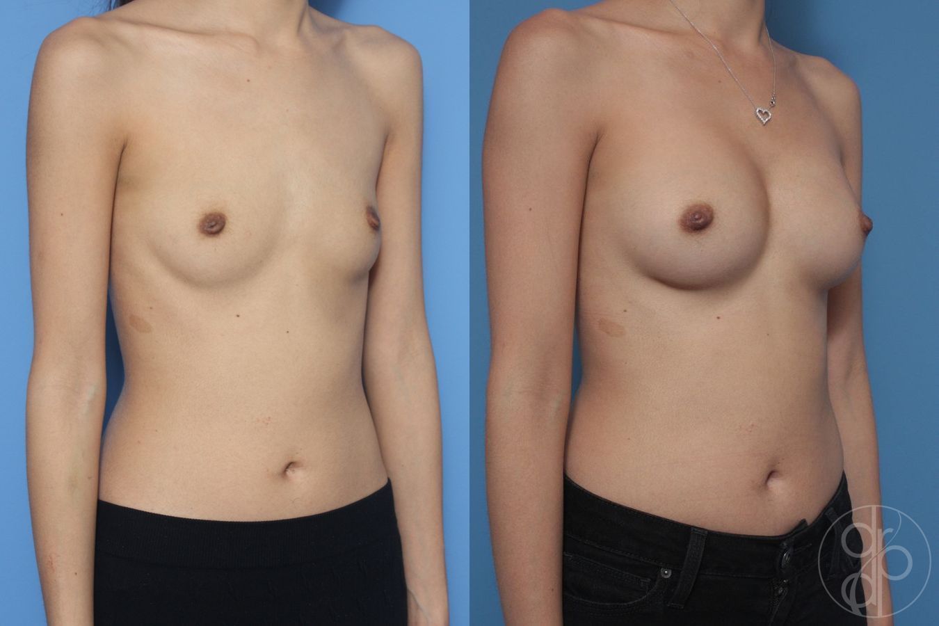 Before and after Breast Augmentation case 29833 - Angle 3