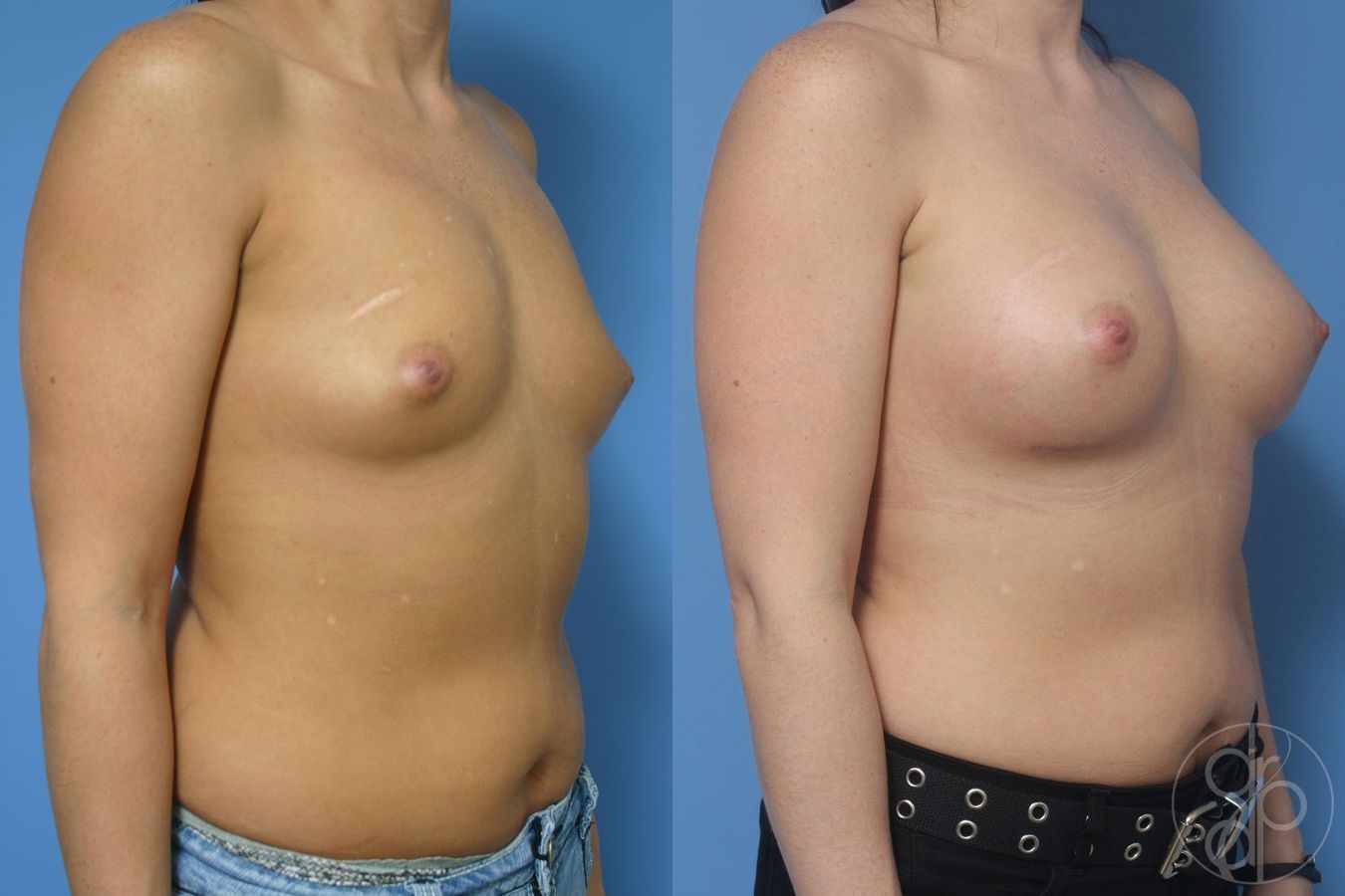 Before and after Breast Augmentation case 29915 - Angle 2