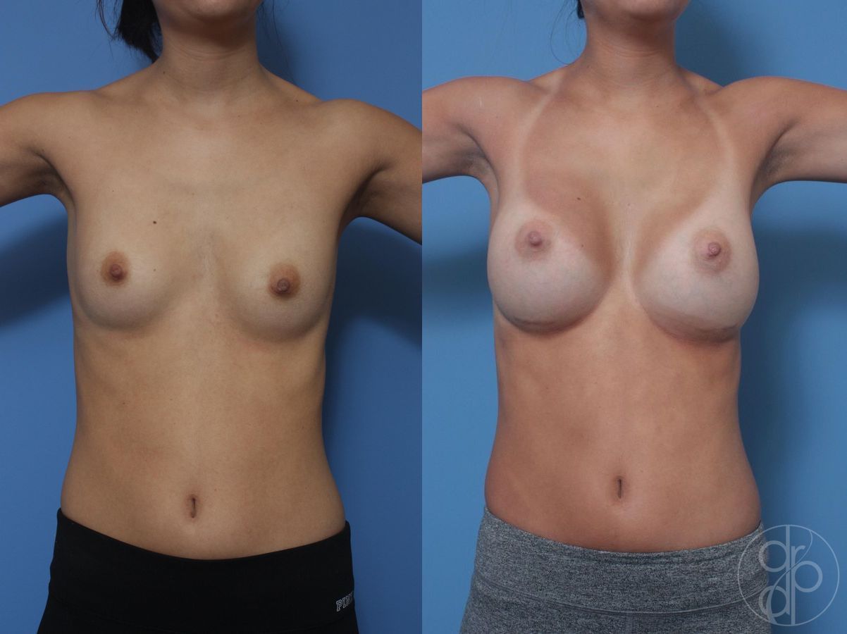 Before and after Breast Augmentation case 29815 - Angle 2