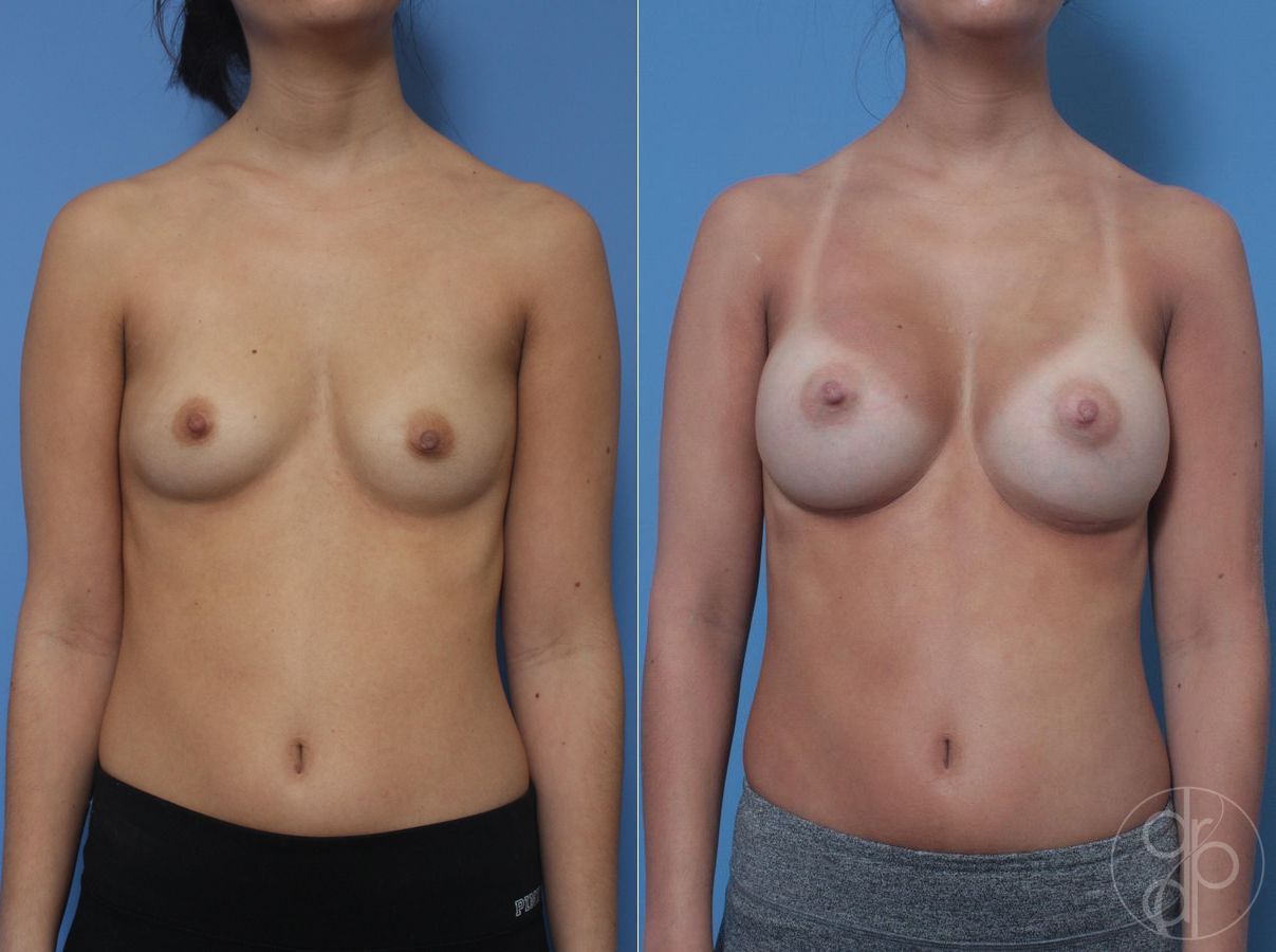 Before and after Breast Augmentation case 29815