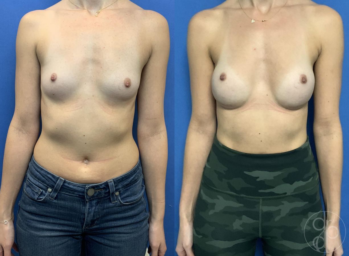 Breast Augmentation - Case 462