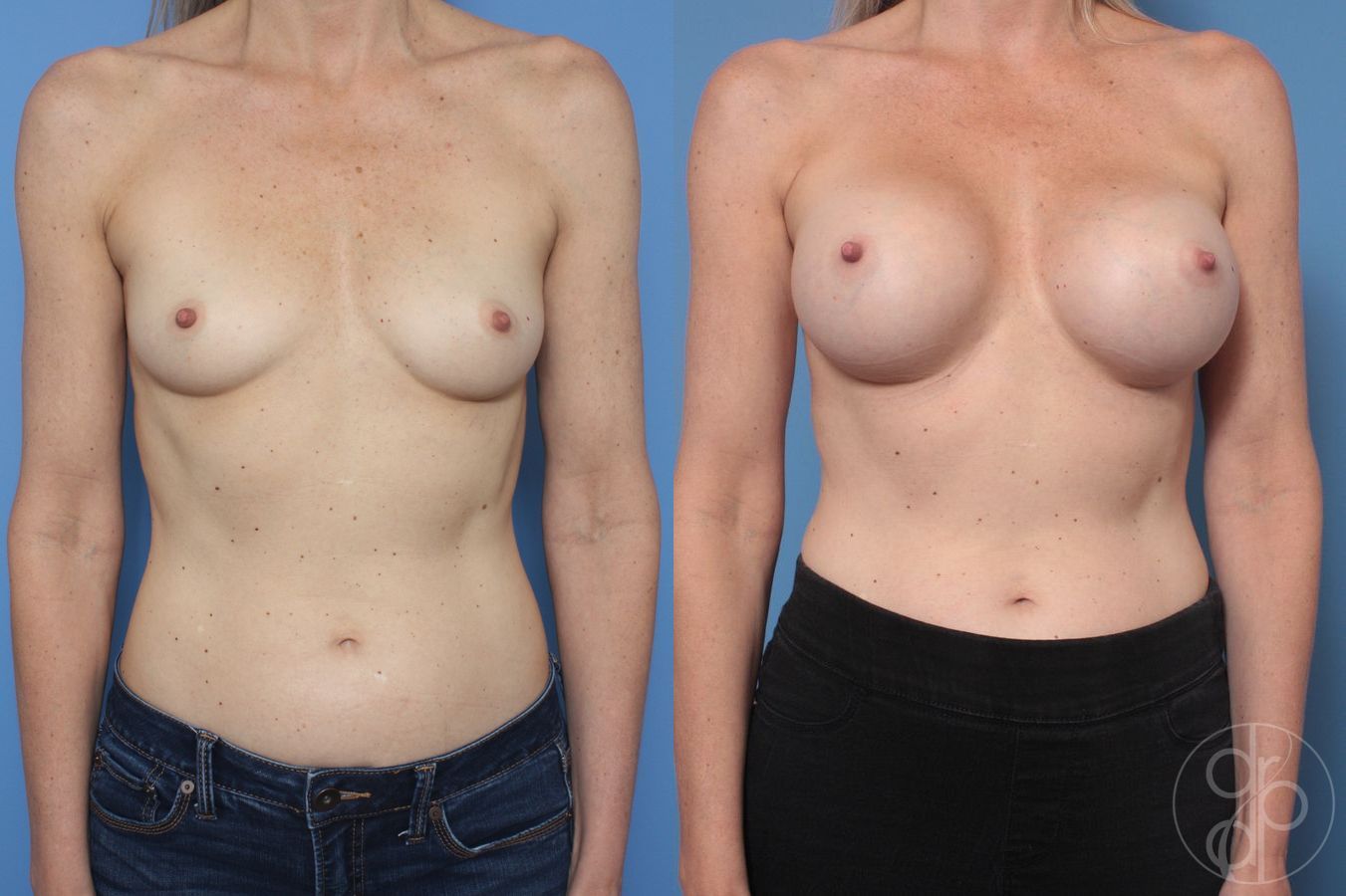 Breast Augmentation - Case 388