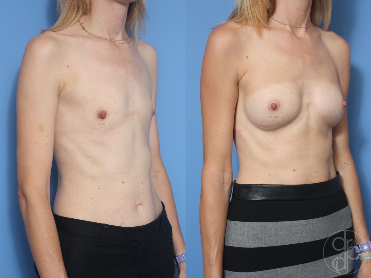 Before and after Breast Augmentation case 29921 - Angle 2