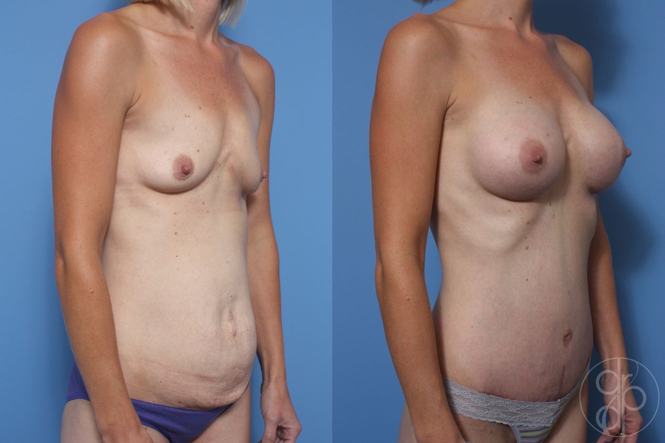 Before and after Breast Augmentation case 29722 - Angle 2