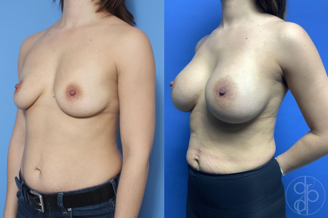 Before and after Breast Augmentation case 29817 - Angle 3