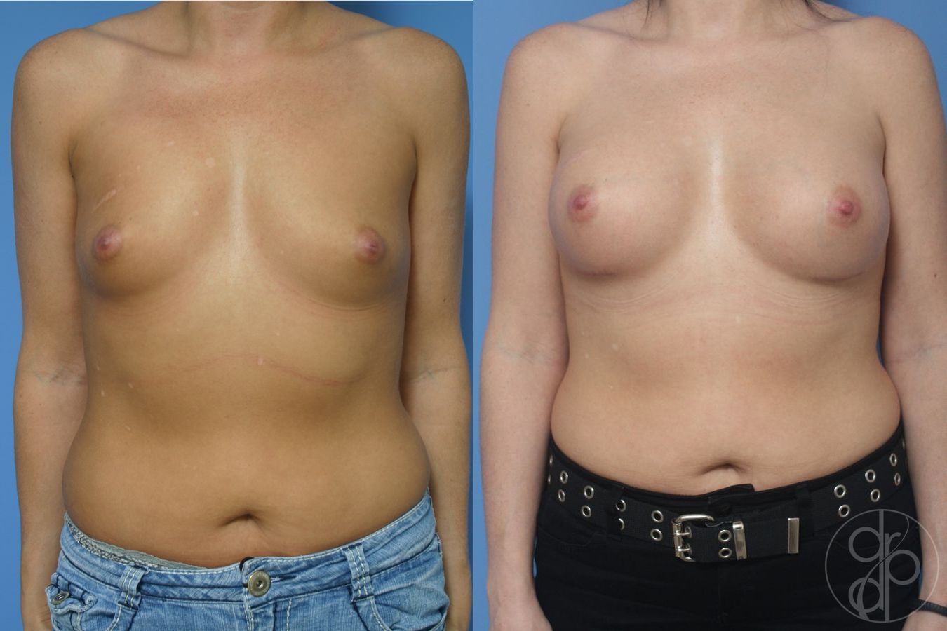 Before and after Breast Augmentation case 29915