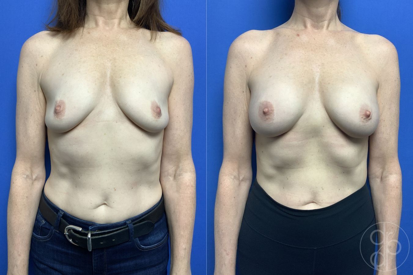 Before and after Breast Augmentation case 29918