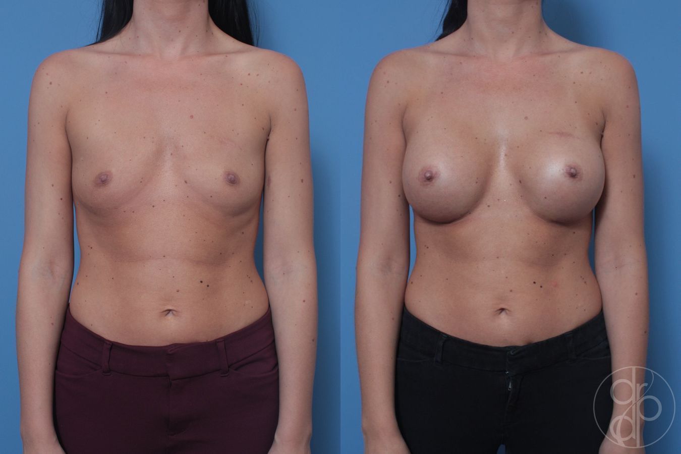 Breast Augmentation - Case 403