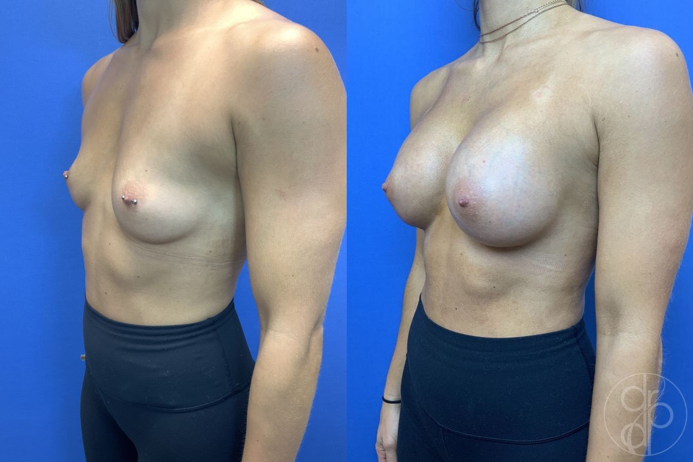Before and after Breast Augmentation case 29941 - Angle 3