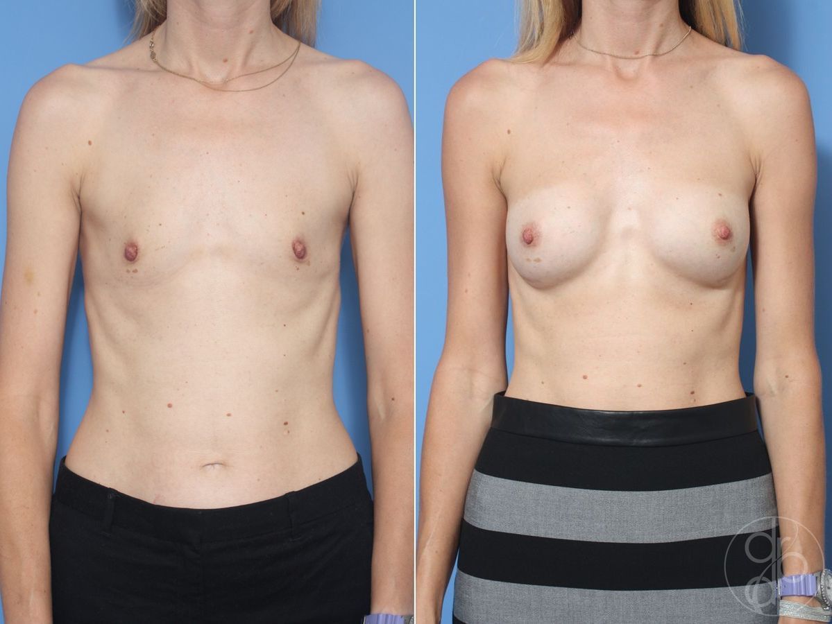Before and after Breast Augmentation case 29921