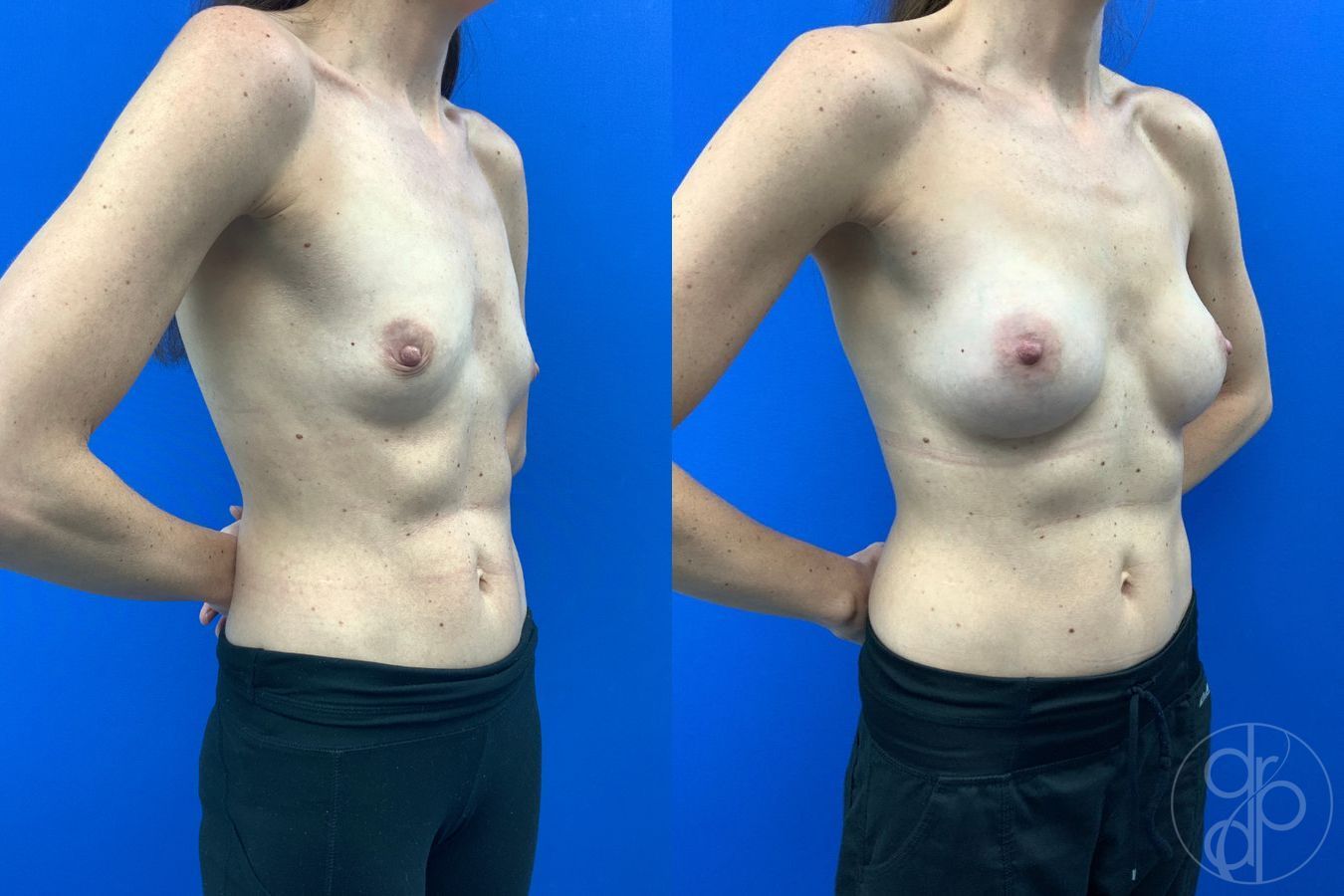 Before and after Breast Augmentation case 43474 - Angle 4
