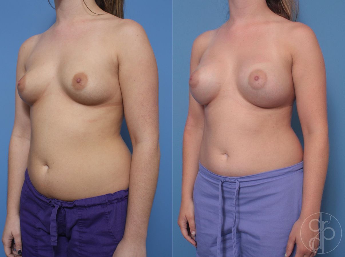 Before and after Breast Augmentation case 29821 - Angle 3