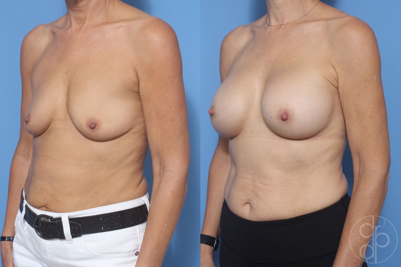 Before and after Breast Augmentation case 29955 - Angle 3