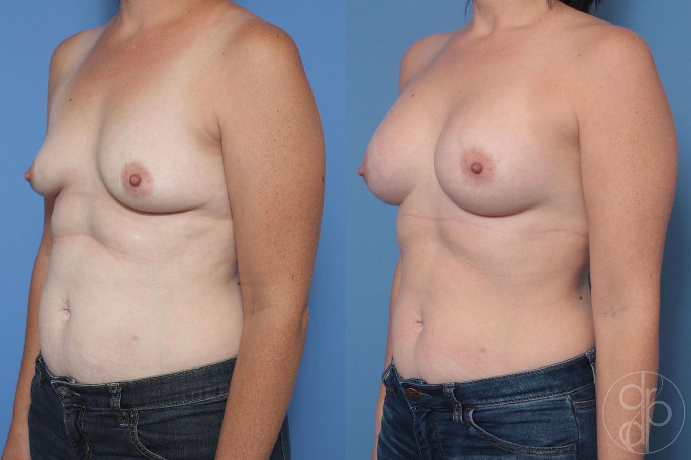 Before and after Breast Augmentation case 29998 - Angle 4