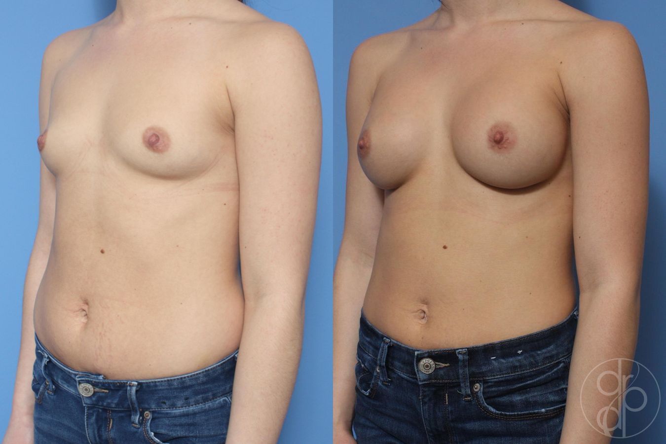 Before and after Breast Augmentation case 30005 - Angle 2