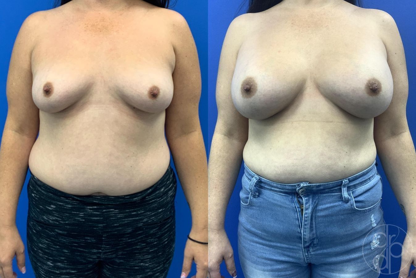 Before and after Breast Augmentation case 29611