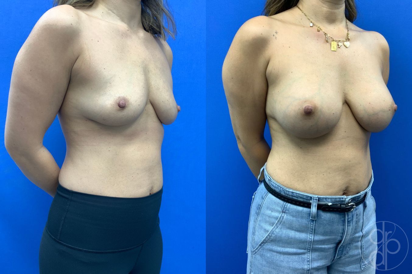 Before and after Breast Augmentation case 46261 - Angle 3