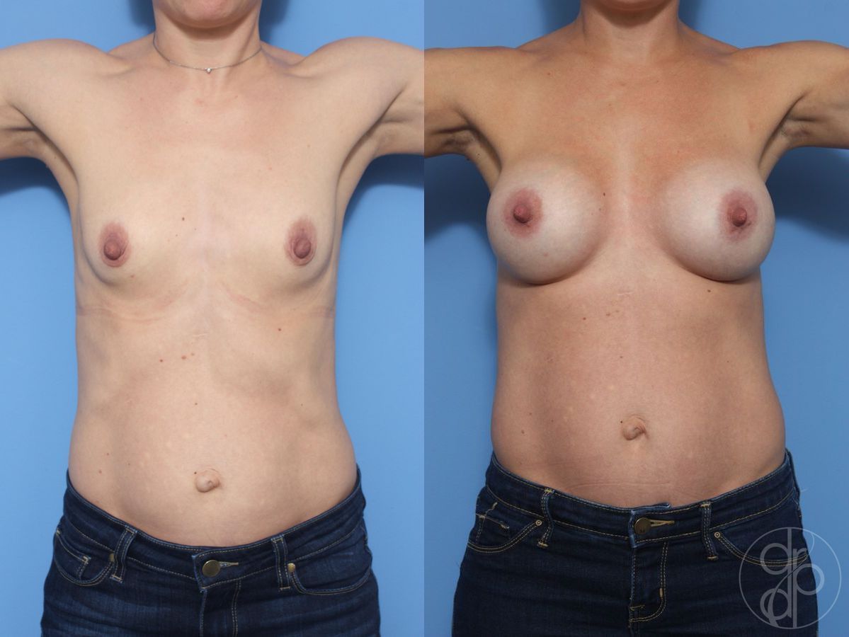 Before and after Breast Augmentation case 29822 - Angle 2