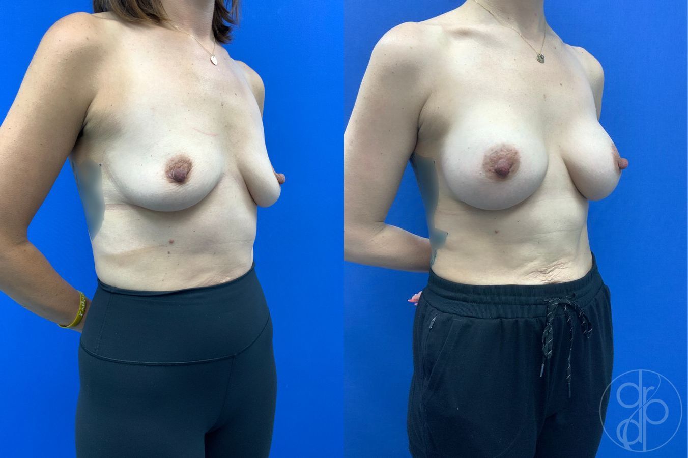 Before and after Breast Augmentation case 46262 - Angle 4