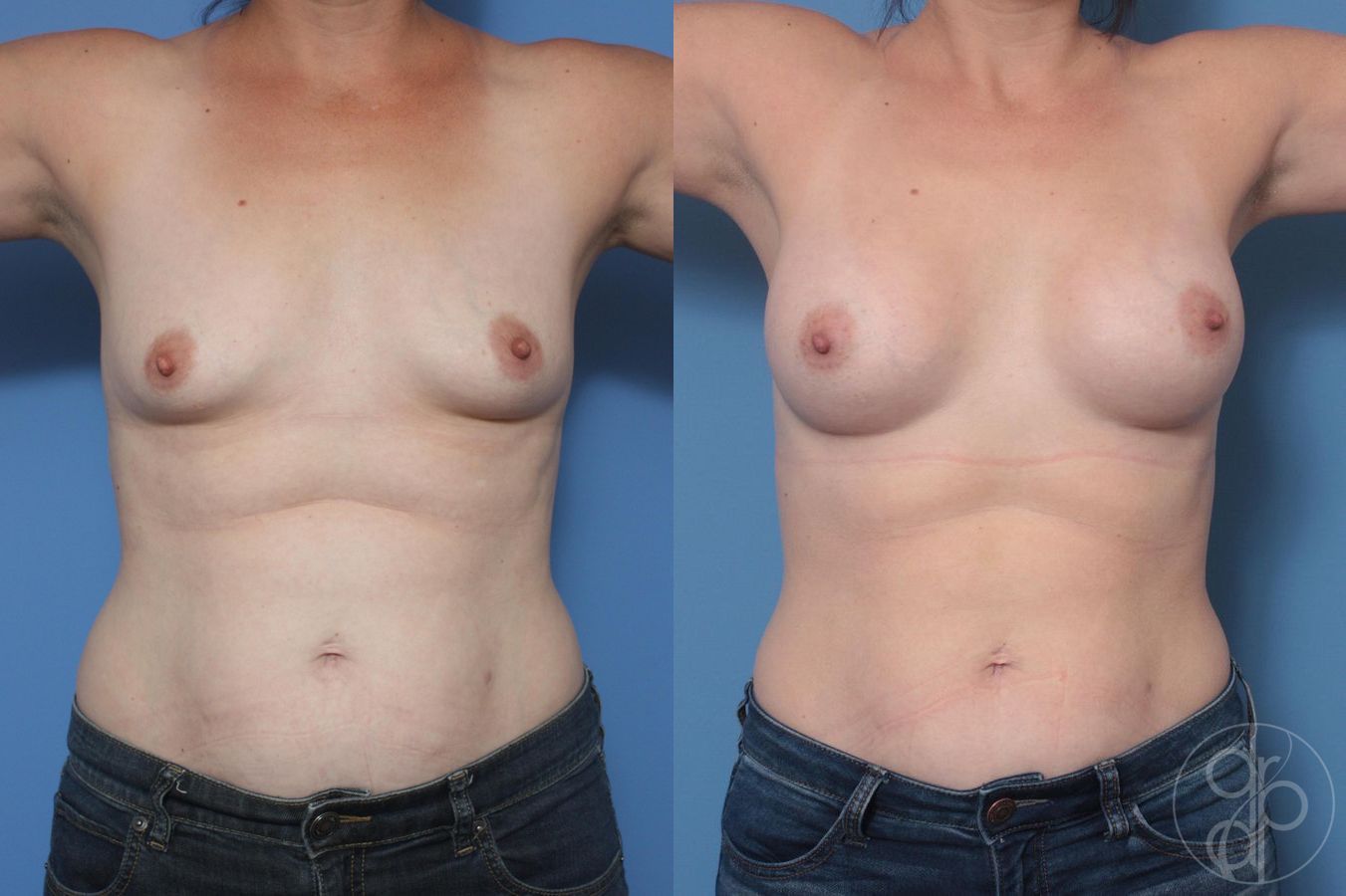 Before and after Breast Augmentation case 29998 - Angle 2