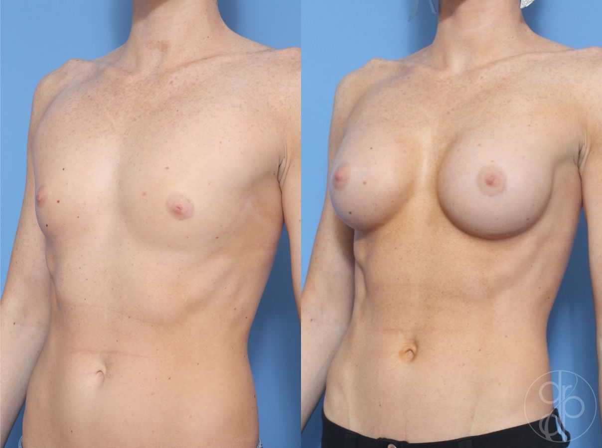 Before and after Breast Augmentation case 29958 - Angle 3