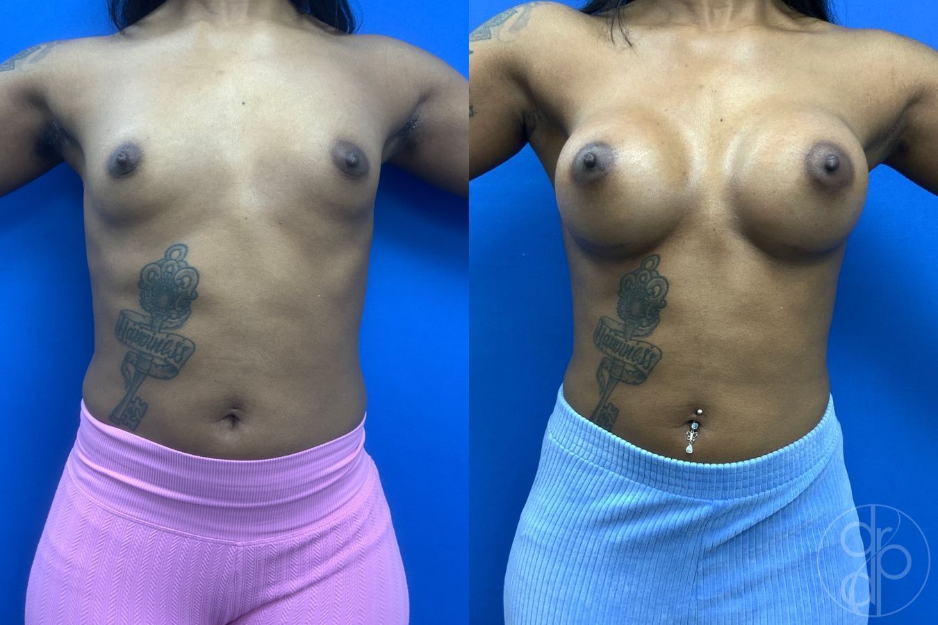 Before and after Breast Augmentation case 43488 - Angle 2