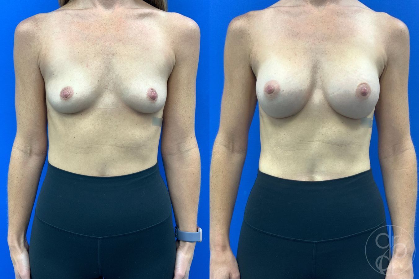 Before and after Breast Augmentation case 46252