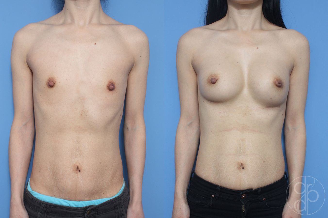 Before and after Breast Augmentation case 29907