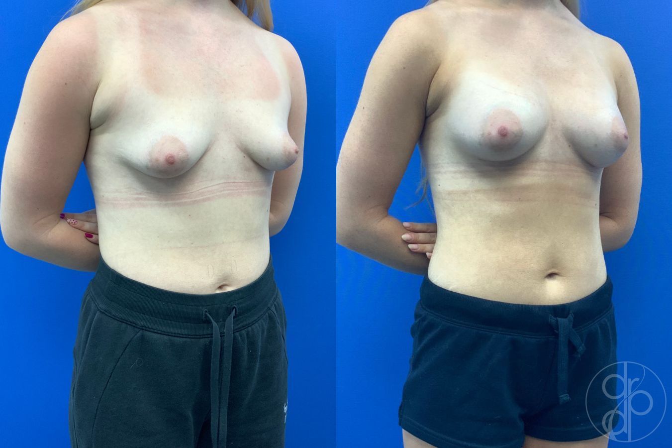 Before and after Tubular Breast Surgery case 46765 - Angle 4