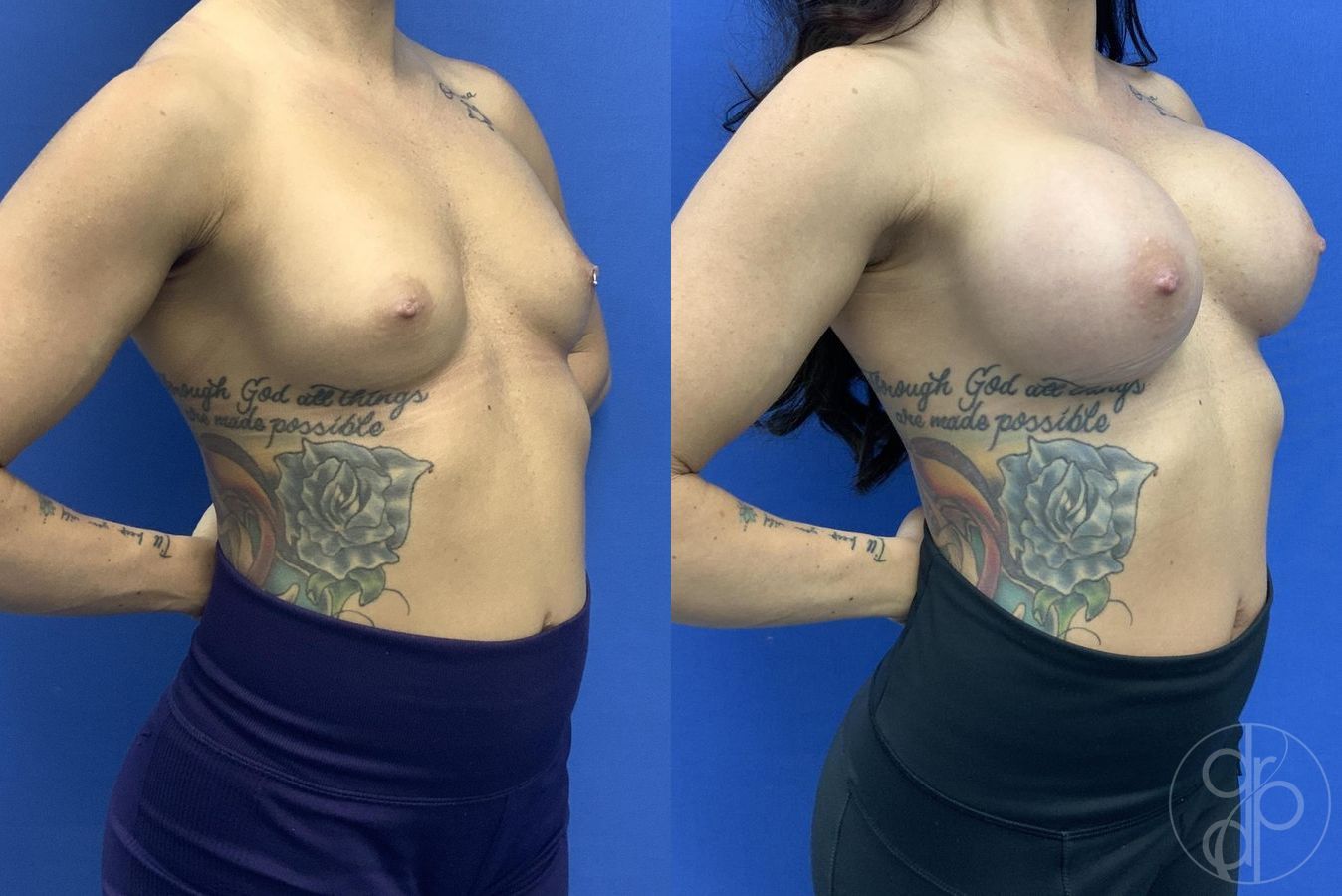 Before and after Breast Augmentation case 29606 - Angle 3