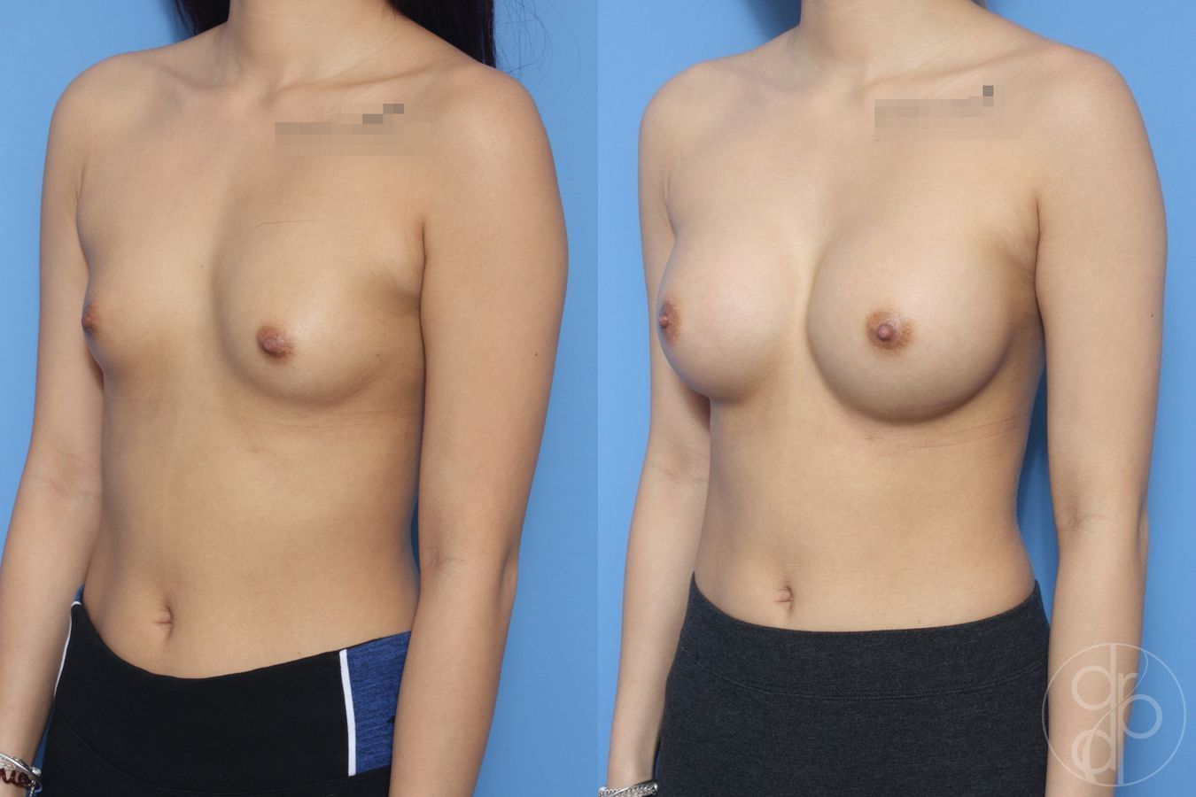 Before and after Breast Augmentation case 29940 - Angle 3