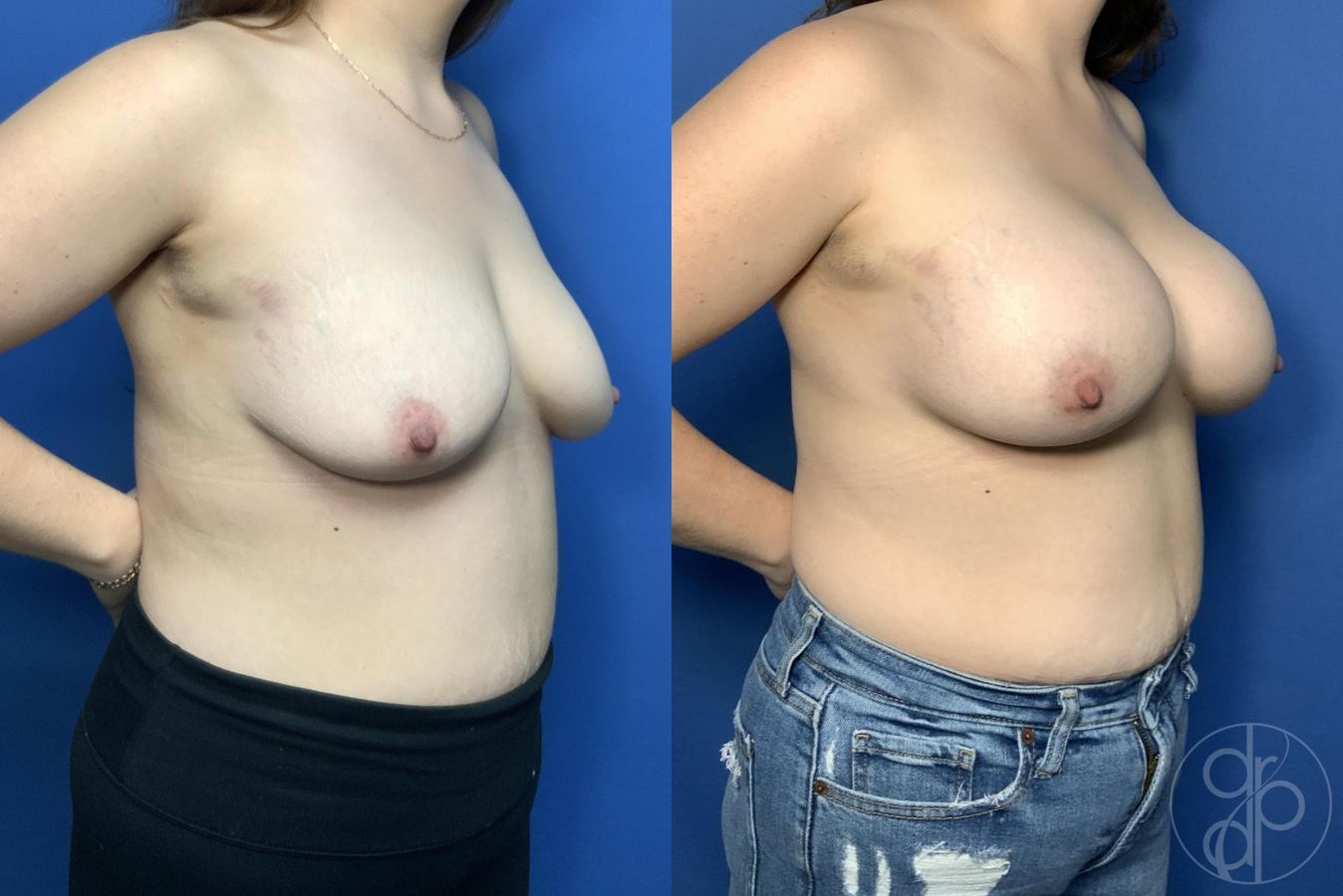 Before and after Breast Augmentation case 29989 - Angle 2