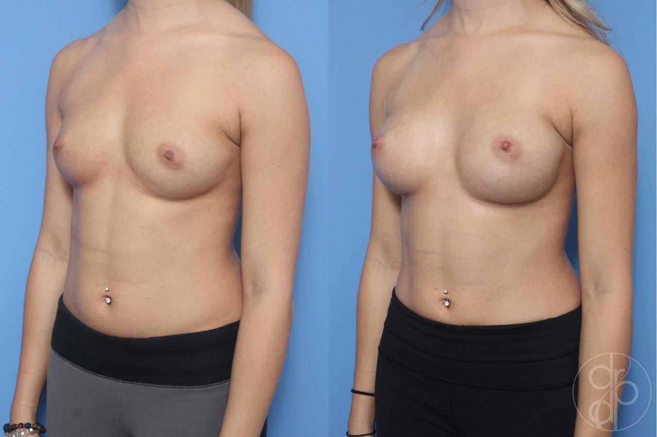 Before and after Breast Augmentation case 29908 - Angle 3