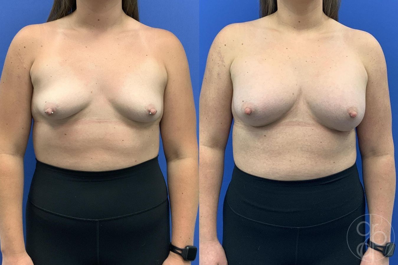 Before and after Breast Augmentation case 30024