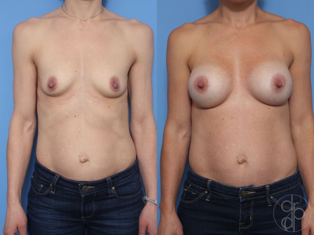 Before and after Breast Augmentation case 29822