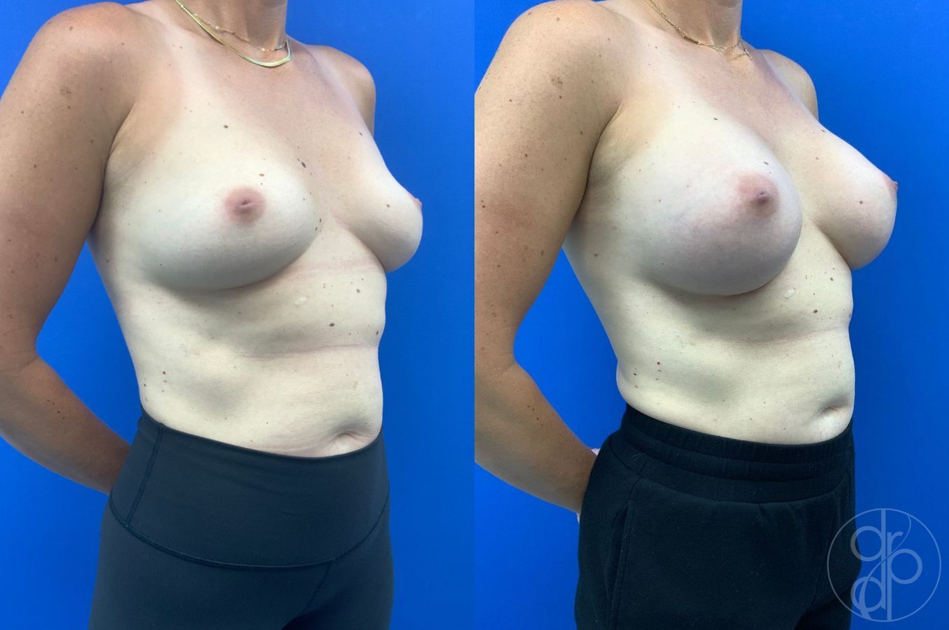 Before and after Breast Augmentation case 46263 - Angle 4