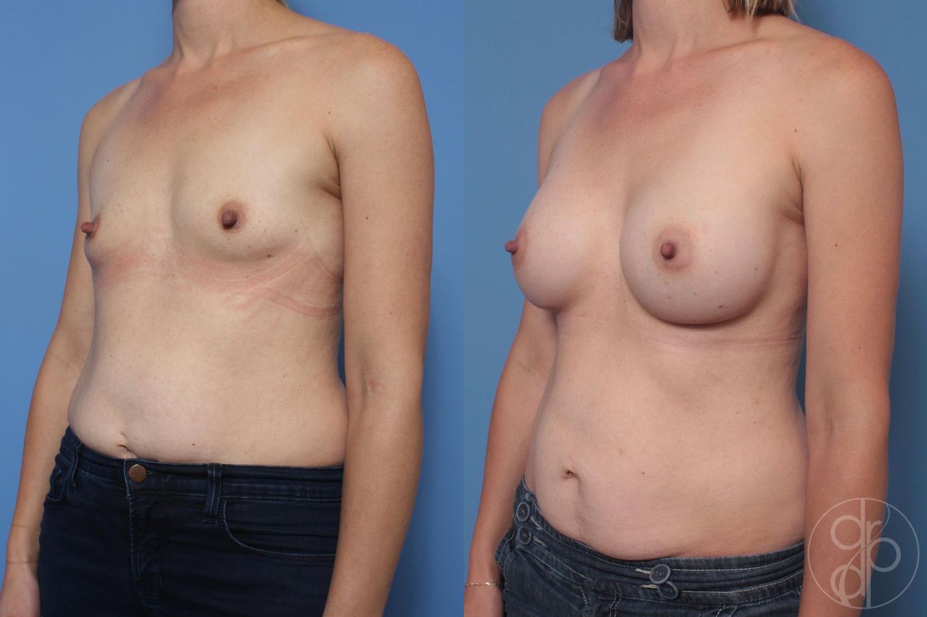 Before and after Breast Augmentation case 29644 - Angle 3