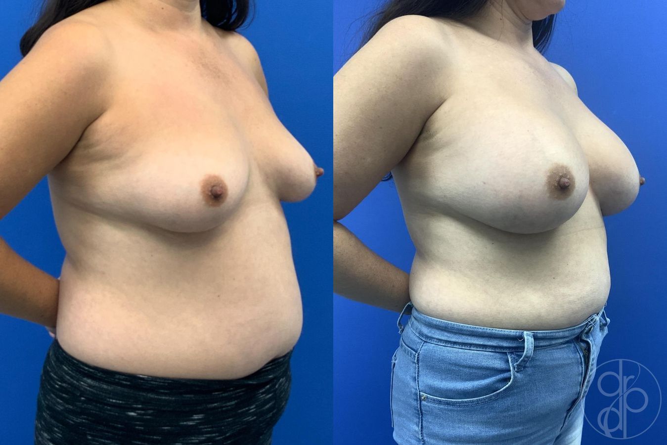 Before and after Breast Augmentation case 29611 - Angle 4