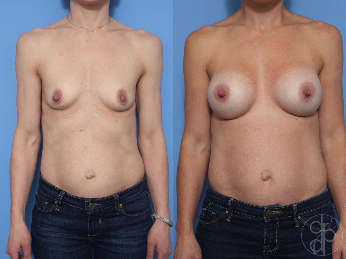 Breast Augmentation - Case 456