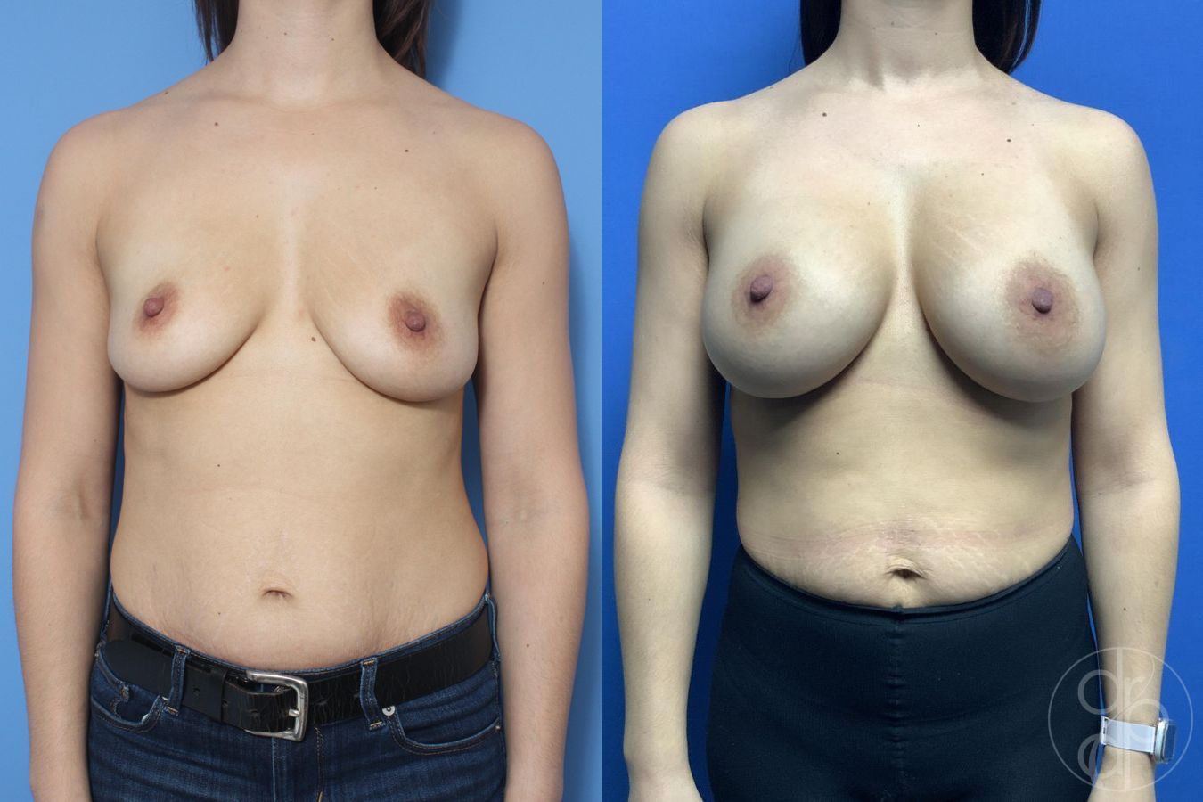 Before and after Breast Augmentation case 29817