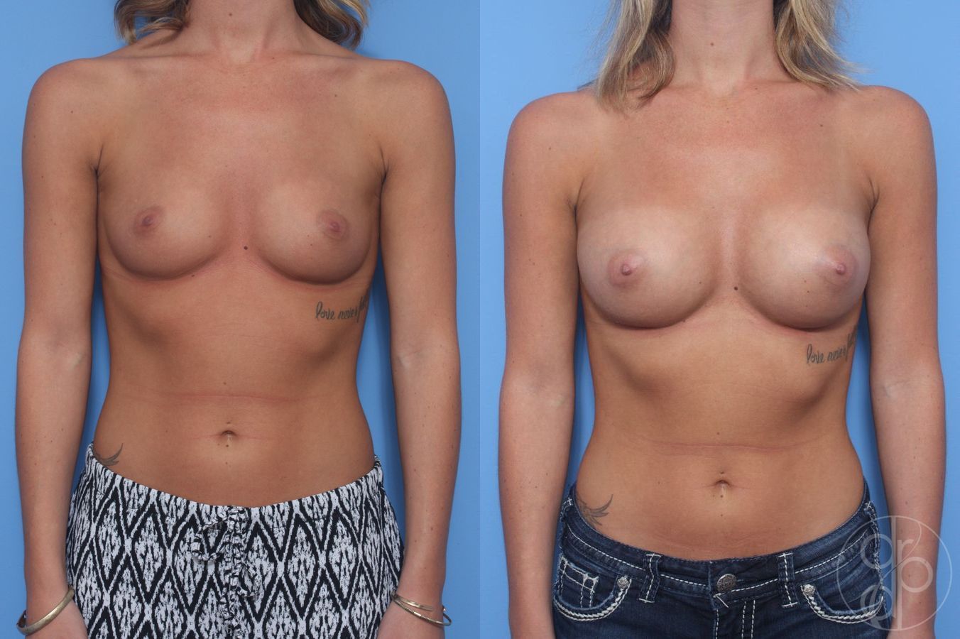 Before and after Breast Augmentation case 29922