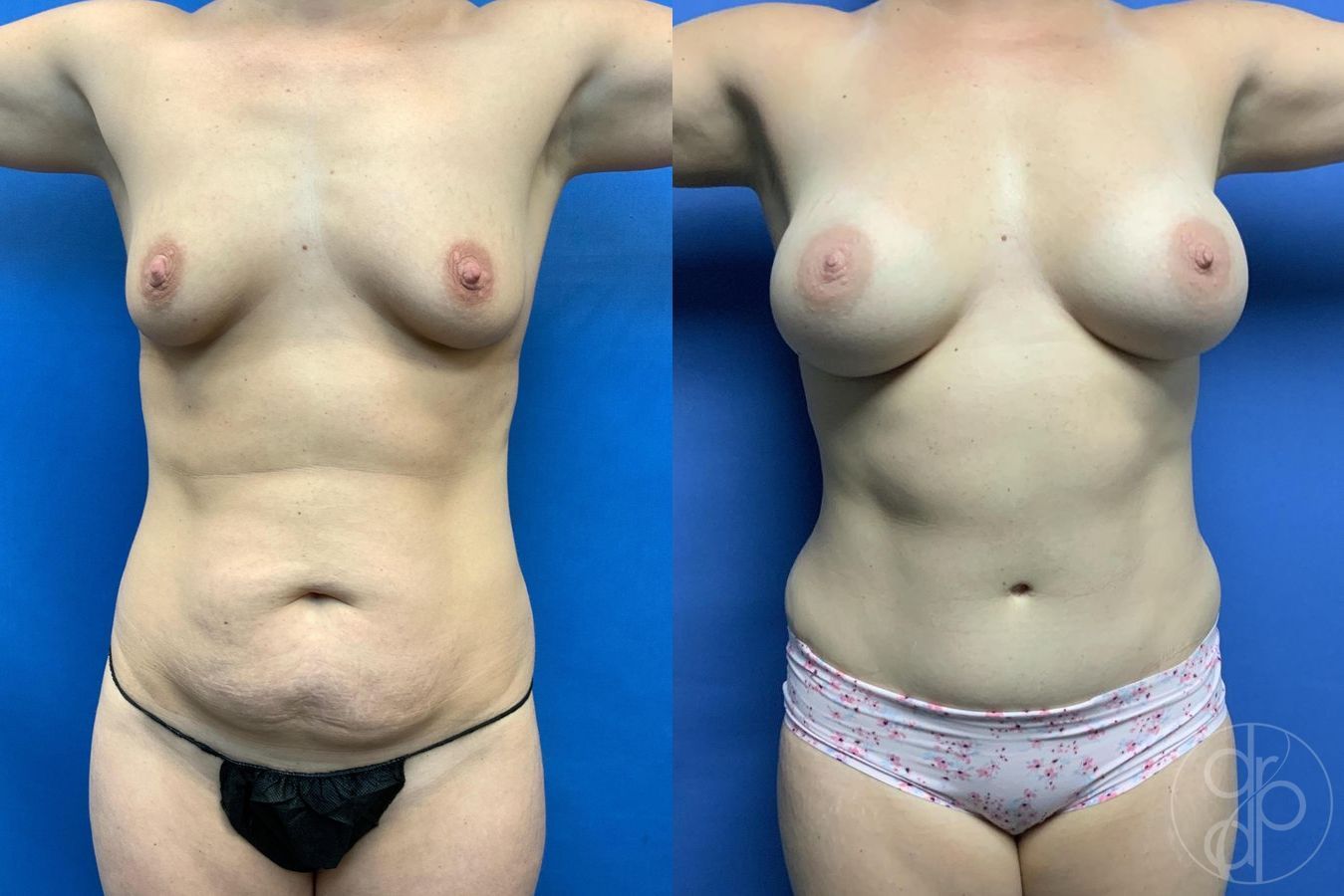 Before and after Breast Augmentation case 29728 - Angle 2