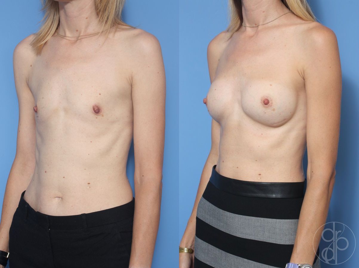 Breast Augmentation - Thumbnail 3