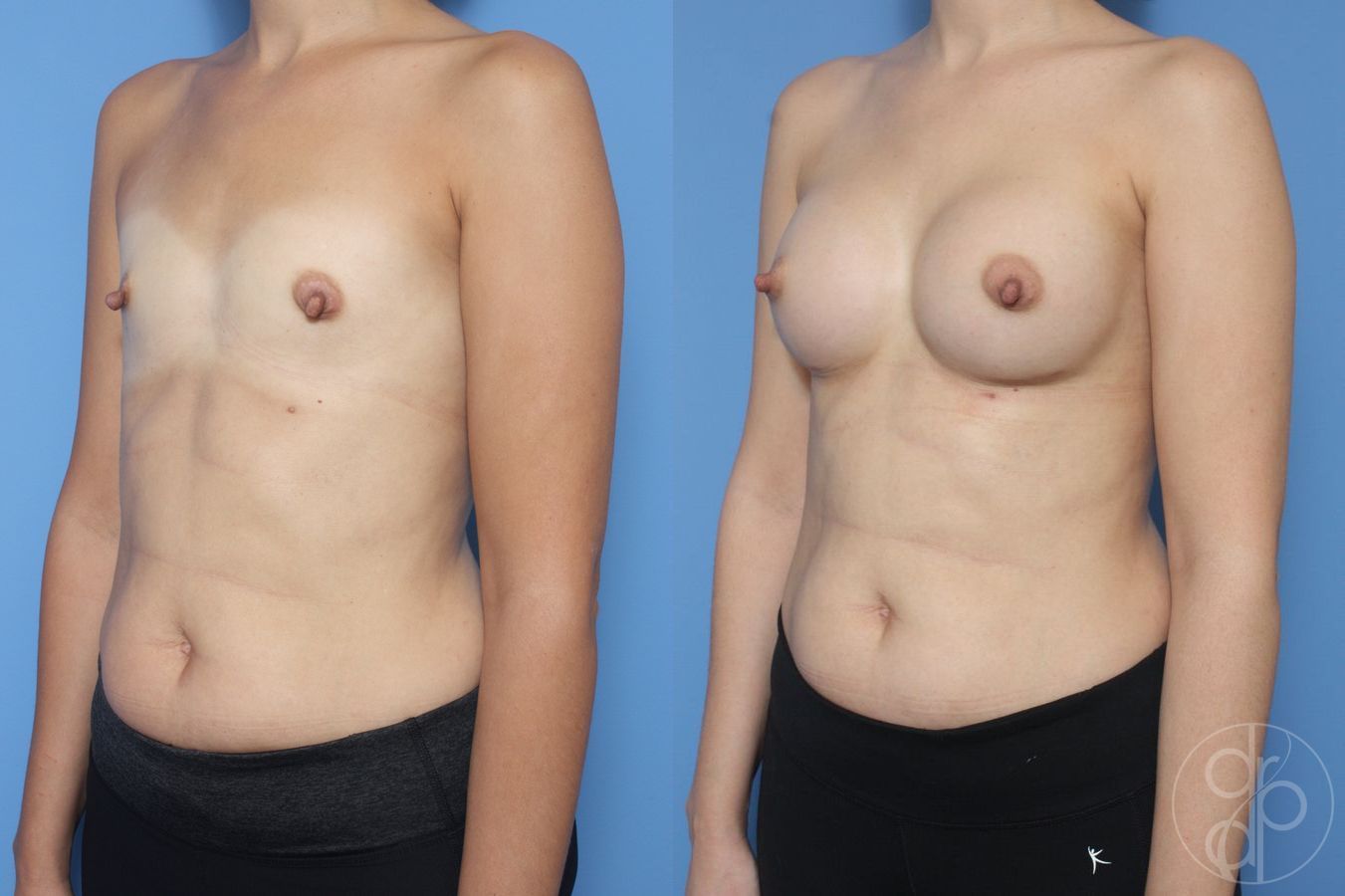 Before and after Breast Augmentation case 29952 - Angle 3