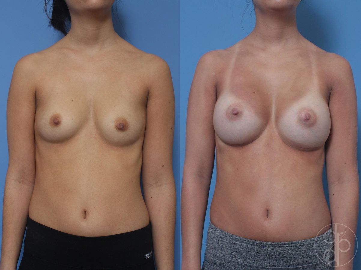 Before and after Breast Augmentation case 29815