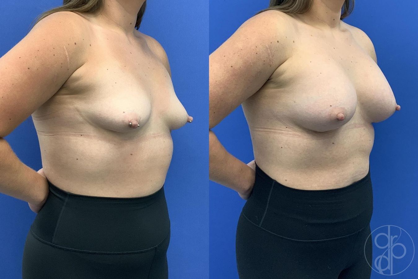 Before and after Breast Augmentation case 30024 - Angle 3